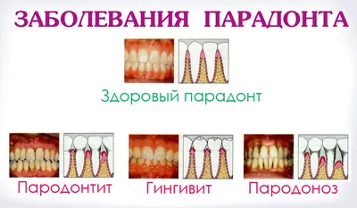 Лечение пародонтоза, пародонтита, гингивита в Днепропетровске | Н-Лайт