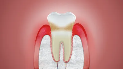 Пародонтоз 9 Фото Лечение В Домашних Условиях ЛюмиДент