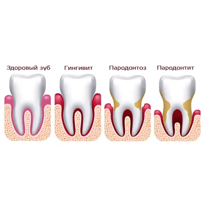 Пародонтит и пародонтоз: симптомы, диагностика, лечение и отличия.