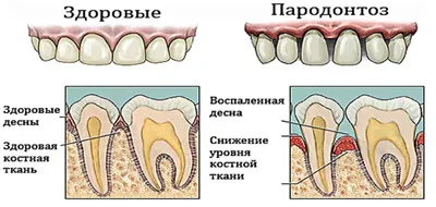 Что такое пародонтоз? Как лечить пародонтоз? Ответы на волнующие вопросы и  рекомендации стоматологов клиники Миллидент в Казани