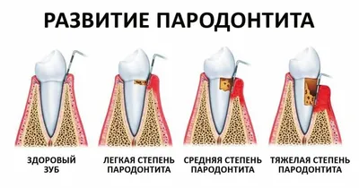 Пародонтоз. Доступная стоматология и имплантация