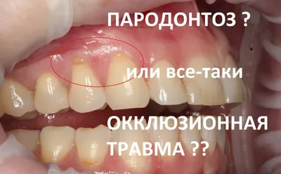 Пародонтоз и пародонтит 🦷 Эффективное лечение десен | iStomatolog, Киев