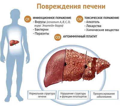 Заболевания печени -симптомы и лечение