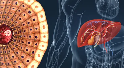 Жировая болезнь печени часто встречается у людей с ВИЧ - Life4me+