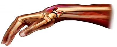 Перелом руки на армрестлинге | Пикабу