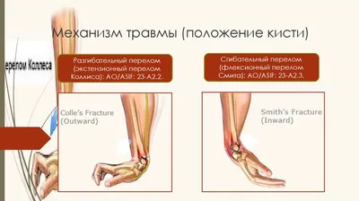 Перелом руки: пластиковый гипс при переломе лучевой кости ОЧЕНЬ УДОБНО! -  YouTube