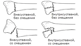 Как избавиться от боли в руке после травмы | Снять боль после перелома или  растяжения запястья | медицинские товары и медтехника в магазине Ортосалон