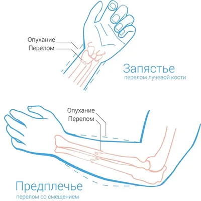 Перелом руки: признаки, симптомы, лечение