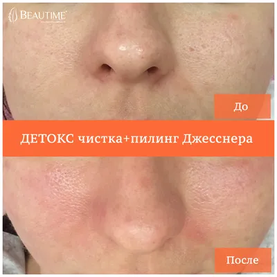 Medic Control Peel Salicylicpeel JS - пилинг Джесснера - 