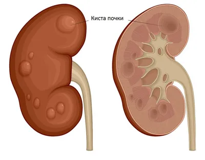 Киста почки - причины образования, диагностика и лечение