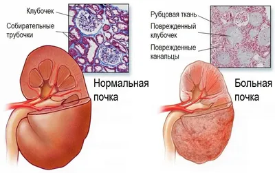 Связь между хронической болезнью почек и микробиотой кишечника