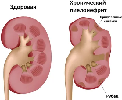 УЗИ диагностика пиелонефрита и рака почек