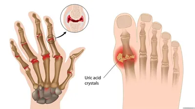 Подагра на руках [симптомы и лечение подагры суставов пальцев]