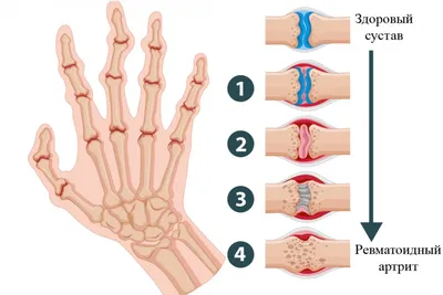 Подагра признаки ,лечение и диагностика | ПРАВДИВАЯ ОНКОЛОГИЯ | Дзен