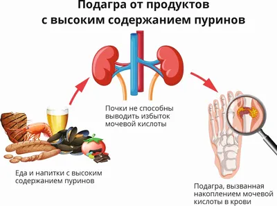 Причины и признаки подагры у мужчин и женщин - АКАДЕРМФАРМ