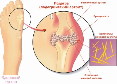 Периартрит суставов рук у мастеров красоты, симптомы, причины, лечение и  профилактика