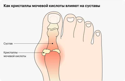 Подагра: что за болезнь, признаки, симптомы, лечение мужчин и женщин,  обострения, диета