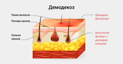 Демодекоз у человека: лечение, симптомы, профилактика