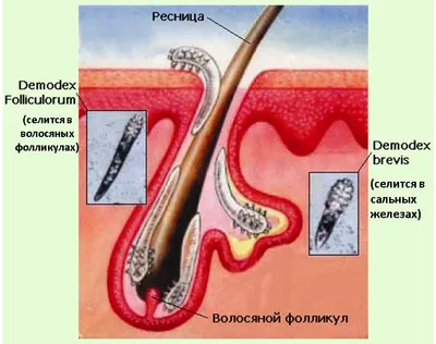 Демодекоз на лице, веках, голове, ресницах - лечение, симптомы, признаки