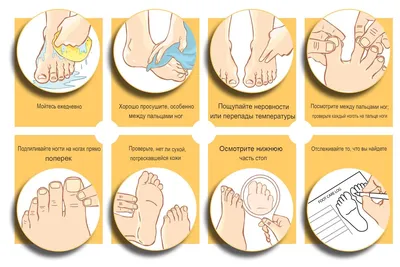 Бородавка между пальцами ног - причины, методы лечения.