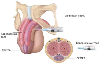 Олеогранулема полового члена - причины, симптомы, диагностика, лечение у  мужчин