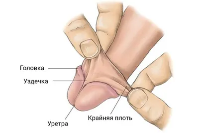 Короткая уздечка полового члена и метод ее коррекции — френулопластика