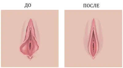 Киста половой губы: причины, симптомы, диагностика, лечение, операция в  клинике «АльтраВита»