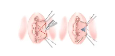 Лазерная лабиопластика половых губ в СПб - Цена коррекции