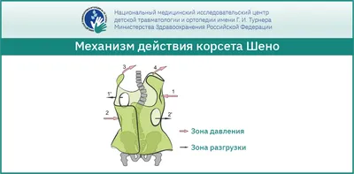 Протрузия межпозвонковых дисков - Центр физической реабилитации и  спортивной медицины EzraMed Clinic