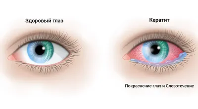 Как подобрать цветные линзы на черные глаза?