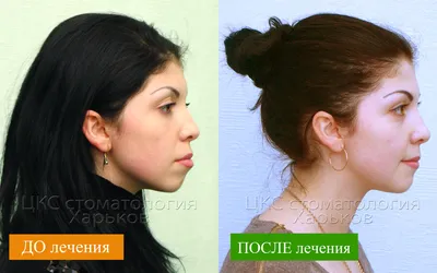 Ортодонтия Лечение брекетами Right Face