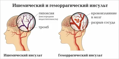 Профилактика инсульта — Школа здоровья — ГБУЗ Городская поликлиника 25 г.  Краснодара МЗ КК