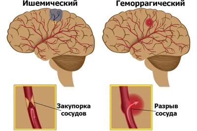 Профилактика инсульта