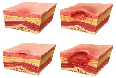 Пролежни на пятках: как лечить? Образования на пятках черного цвета у  лежачих больных (фото) - Инновационный сосудистый центр