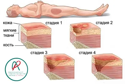 Стадии пролежней