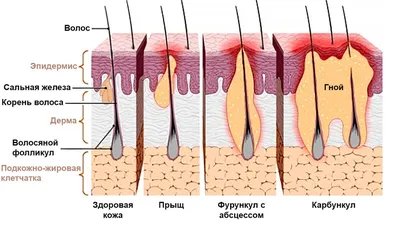 О чем говорят прыщи на лице?