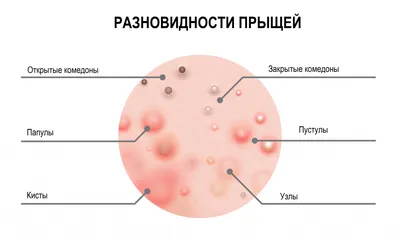 Прыщи на лице [угри, высыпания] — причины, виды акне, что делать