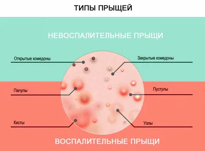 Как убрать прыщи на лице