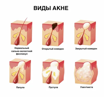 О чем говорят прыщи на лице?