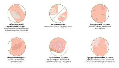 Что такое псориаз и каковы причины его возникновения - Береги себя для  жизни - 39-я городская клиническая поликлиника