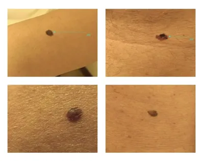 Как выглядит рак кожи — признаки и симптомы меланомы, базалиомы и  плоскоклеточной карциномы