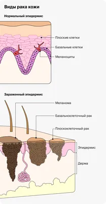 Рак кожи – что означает диагноз, которого боятся даже самые стойкие -  Медицинский центр "Допомога+"