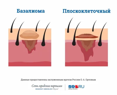 Меланома кожи: стадии, фото и процедура лечения. Онкология