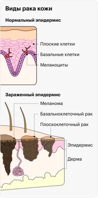 Как выглядит РАК КОЖИ (фото 1-8). Меланома, базалиома и плоскоклеточный рак  кожи - YouTube