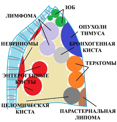 Опухоли средостенья – разнообразие морфологических форм, лечебных  алгоритмов и тактических ошибок - YouTube