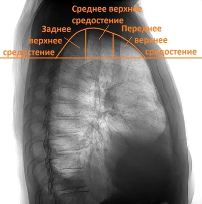 Рак трахеи - симптомы и причины, лечение