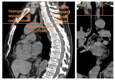 Рентгеновская диагностика заболеваний верхнего средостения | Второе мнение