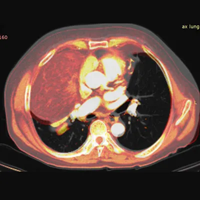 Резекция доли легкого в израильской клинике Ихилов : Armedical