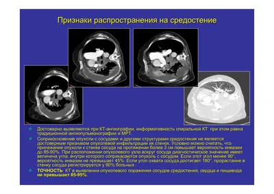 Тимома (опухоль вилочковой железы) - симптомы, причины, диагностика и  лечение в лучших клиниках