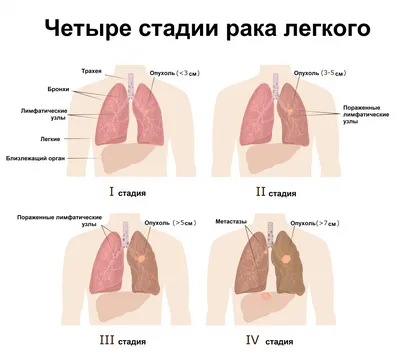 Хирургия. Средостение. Опухоль | Пикабу